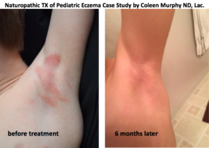 Case Study-Naturopathic Treatment of Pediatric Eczema